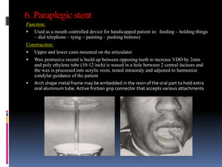 6. Paraplegic stent
Function:
 Used as a mouth controlled device for handicapped patient in: feeding – holding things
– dial telephone – tying – painting – pushing buttons)
Construction:
 Upper and lower casts mounted on the articulator
 Wax protrusive record is build up between opposing teeth to increase VDO by 2mm
and poly ethylene tube (10-12 inch) is waxed in a hole between 2 central incisors and
the wax is processed into acrylic resin, tested intraoraly and adjusted to harmonize
condylar guidance of the patient
 Arch shape metal frame may be embedded in the resin of the oral part to hold extra
oral aluminum tube. Active friction grip connector that accepts various attachments
 