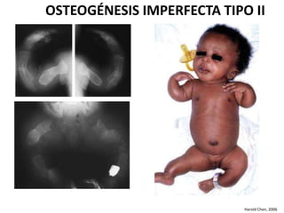 OSTEOGÉNESIS IMPERFECTA TIPO II 
Harold Chen, 2006 
 