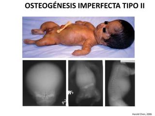 OSTEOGÉNESIS IMPERFECTA TIPO II 
Harold Chen, 2006 
 
