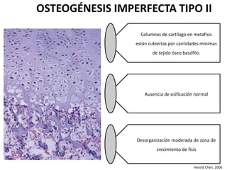OSTEOGÉNESIS IMPERFECTA TIPO II 
Columnas de cartílago en metafisis 
están cubiertas por cantidades mínimas 
de tejido óseo basófilo. 
Ausencia de osificación normal 
Desorganización moderada de zona de 
crecimiento de fisis 
Harold Chen, 2006 
 