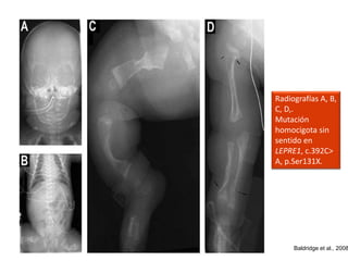 Radiografías A, B, 
C, D,. 
Mutación 
homocigota sin 
sentido en 
LEPRE1, c.392C> 
A, p.Ser131X. 
Baldridge et al., 2008 
 