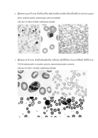 6. ผูปวยชาย อายุ 30 ป มารพ. ดวยเรื่องเหนื่อย เพลีย ตัวเหลือง ตาเหลือง เปนมาตั้งแตเด็ก ตรวจรางกาย marked
    pallor, moderate jaundice, hepatomegaly, spleen not palpable
    CBC Hct 17% MCV 60 WBC 7,800 Platelet 450,000




7. ผูปวยชาย 60 ป มารพ. ดวยเรื่องเดินเซดานซาย เหนื่อยงาย เดินไดไมไกล กินอาหารไดปกติ ไมมไข ตรวจ
                                                                                                 ี
    รางกาย moderate pallor, no jaundice, glossitis, impaired proprioceptive sensation
    CBC Hct 21% MCV 120 WBC 5,000 Platelet 240,000




                                                                                                           15
 