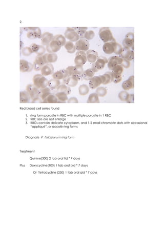2.




Red blood cell series found

       1. ring form parasite in RBC with multiple parasite in 1 RBC
       2. RBC size are not enlarge
       3. RBCs contain delicate cytoplasm, and 1-2 small chromatin dots with occasional
          “appliqué”, or accolé ring forms


       Diagnosis P. falciparum ring form



Treatment

         Quinine(300) 2 tab oral tid * 7 days

Plus     Doxycycline(100) 1 tab oral bid * 7 days

            Or Tetracycline (250) 1 tab oral qid * 7 days




                                                                                          19
 