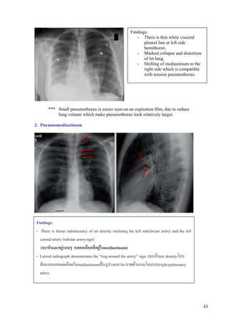 Findings:
                                                            - There is thin white visceral
                                                                pleural line at left side
                                                                hemithorax.
                                                            - Marked collapse and distortion
                                                                of let lung.
                                                            - Shifting of mediastinum to the
                                                                right side which is compatible
                                                                with tension pneumothorax.




       *** Small pneumothorax is easier seen on an expiration film, due to reduce
           lung volume which make pneumothorax look relatively larger.

2. Pneumomediastinum




Findings:
- There is linear radiolucency of air density outlining the left subclavian artery and the left
  carotid artery (tubular arterysign).
  (จะเห็นairอยูรอบๆ หลอดเลือดที่อยูในmediastinum)
- Lateral radiograph demonstrates the “ring around the artery” sign. (จะเห็นair densityโอบ
  ลอมรอบหลอดเลือดในmediastinumเปนรูปวงแหวน ภาพดานบนโอบรอบright pulmonary
  artery.




                                                                                                  43
 