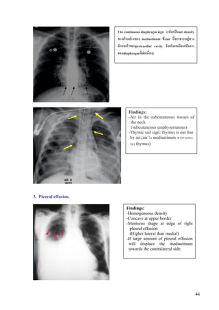 The continuous diaphragm sign (เห็นเปนair density
                       ทางดานลางของ mediastinum ซึ่งair นี้จะเซาะอยูทาง
                       ดานหนาของpericardial cavity จึงเห็นเหมือนเปนเงา
                       ของdiaphragmที่ตอเนื่อง)




                              Findings:
                              -Air in the subcutaneous tissues of
                               the neck
                               (subcutaneous emphysematous)
                              -Thymic sail sign: thymus is out line
                               by air.(air ใน mediastinum เซาะตามขอบ
                               ของ thymus)




3. Pleural effusion.

                            Findings:
                            -Homogeneous density
                            -Concave at upper border
                            -Meniscus shape at edge of right
                              pleural effusion
                              (Higher lateral than medial)
                            -If large amount of pleural effusion
                             will displace the mediastinum
                             towards the contralateral side.




                                                                             44
 