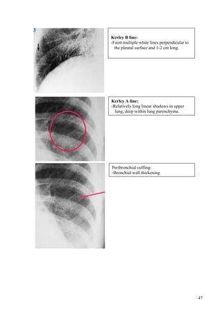 Kerley B line:
-Faint multiple white lines perpendicular to
  the pleural surface and 1-2 cm long.




Kerley A line:
-Relatively long linear shadows in upper
  lung, deep within lung parenchyma.




Peribronchial cuffing:
-Bronchial wall thickening




                                               47
 
