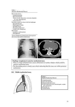 Findings: lymphoma in anterior mediastinal mass
 -There is a large lobulated mass causes obliteration of cardiac shadow which could be
  anterior mediastinal mass.
 -The descending aorta is clearly seen which indicating that this mass not within posterior
  mediastinm.

10.2 Middle mediastinal mass




                                                                                              51
 