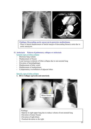 Findings: Descending aortic aneurysm in posterior mediastinum.
       -There is lateral displacement of lateral margin of descending thoracic aorta due to
        aortic aneurysm.


11. Atelectasis Pattern of pulmonary collapse or atelectasis
    General signs of lobar collapse
    - Decrease lung volume
    - Displacement of fissure
    - Local increase in density of lobar collapse due to non-aerated lung
    - Elevation of hemidiaphragm
    - Displacement of hilar vessel
    - Displacement of mediastinum
    - Compensatory overinflation of adjacent lobes.

   Specific sign of lobar collapse
   1. RUL-Collapse upwards and anteriorly




                                     Minor fissure




         Findings:
         -Opacity in right upper lung due to reduce volume of non-areated lung
         -Elevation of minor fissure
         -Elevation of right hilum
         -Tracheal deviation to the right
                                                                                              53
 