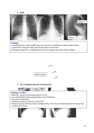 2. RML



                                                                                              Minor f




                                                                              Major f

Findings:
-Increase density in right middle lung zone with loss of definition of right cardiac border
-Lateral film: triangular shape opacity projected over the heart
(Triangular shapeเกิดจากการdisplacementของminorและmajor fissureเขาหาlobar collapse)




                                Major fissure




       3. LUL-Collapses upwards and anteriorly



Findings: PA film
-Decrease volume with increase density of LUL
-Loss of definition of left cardiac border and of left hilum
-Elevation of left hilum
-Tracheal deviation to the left Lateral film
-Increase opacity anteriorly (due to collapse lobe), which has well-defined posterior margin due
  to left major fissure




                                                                                                    54
 