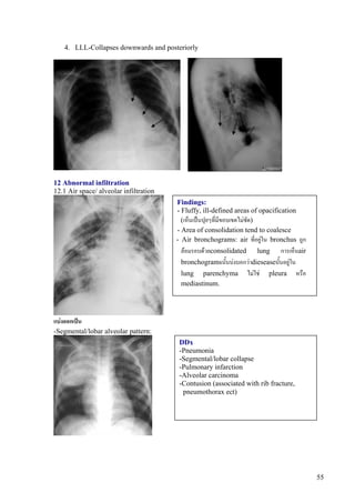 4. LLL-Collapses downwards and posteriorly




12 Abnormal infiltration
12.1 Air space/ alveolar infiltration
                                        Findings:
                                        - Fluffy, ill-defined areas of opacification
                                          (เห็นเปนปุยๆที่มีขอบเขตไมชัด)
                                        - Area of consolidation tend to coalesce
                                        - Air bronchograms: air ที่อยูใน bronchus ถูก
                                         ลอมรอบดวยconsolidated lung การเห็นair
                                         bronchogramsนั้นบงบอกวาdieseaseนั้นอยูใน
                                         lung parenchyma ไมใช pleura หรือ
                                         mediastinum.




แบงออกเปน
-Segmental/lobar alveolar pattern:
                                         DDx
                                         -Pneumonia
                                         -Segmental/lobar collapse
                                         -Pulmonary infarction
                                         -Alveolar carcinoma
                                         -Contusion (associated with rib fracture,
                                          pneumothorax ect)




                                                                                         55
 