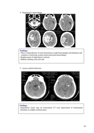 4. Hypertensive hemorrhage




Findings:
-There is hyperdensity of acute hematoma at right basal ganglia and thalamus and
 extends to ventricular system (intraventricular hemorrhage).
-Displacement of right lateral ventricle
-Midline shifting to the left side



5. Acute cerebral infarction




Findings:
-Hyperdense artery sign on noncontrast CT scan represented of intraluminal
 thrombus in middle cerebral artery




                                                                                   60
 