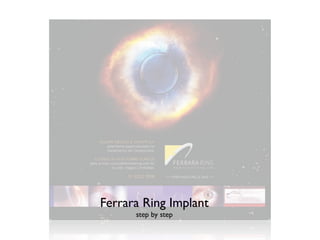 Ferrara Ring Implant
      step by step
 