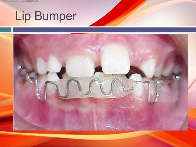 step by step fixed orthodontics designer teeth braces