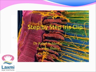 Step by Step Iris Clip
Dr Rahul Achlerkar
Dr Vijay Shetty
 