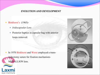  Binkhorst’s (1965)-
 Iridocapsular Lens
 Posterior haptics in capsular bag with anterior
loops removed.
 In 1970 Binkhorst and Worst employed a trans-
iridectomy suture for fixation mechanism-
MEDALLION lens.
EVOLUTION AND DEVELOPMENT
 