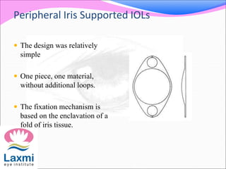 Peripheral Iris Supported IOLs
 The design was relatively
simple
 One piece, one material,
without additional loops.
 The fixation mechanism is
based on the enclavation of a
fold of iris tissue.
 