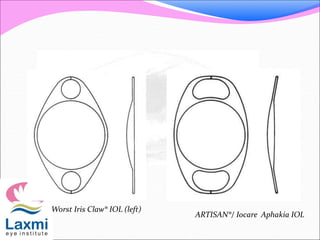 Worst Iris Claw® IOL (left)
ARTISAN®/ Iocare Aphakia IOL
 