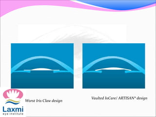 Worst Iris Claw design
Vaulted IoCare/ ARTISAN® design
 
