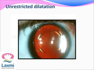 Unrestricted dilatation
 