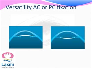 Versatility AC or PC fixation
 