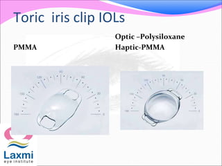 Toric iris clip IOLs
PMMA
Optic –Polysiloxane
Haptic-PMMA
 