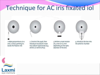 Technique for AC iris fixated iol
 