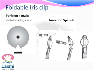 Foldable Iris clip
Perform a main
incision of 3.2 mm Insertion Spatula
 