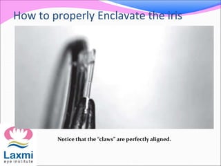 How to properly Enclavate the iris
Notice that the “claws” are perfectly aligned.
 