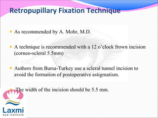 Retropupillary Fixation Technique
 As recommended by A. Mohr, M.D.
 A technique is recommended with a 12 o’clock frown incision
(corneo-scleral 5.5mm)
 Authors from Bursa-Turkey use a scleral tunnel incision to
avoid the formation of postoperative astigmatism.
 The width of the incision should be 5.5 mm.
 