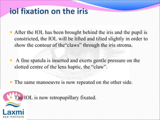 iol fixation on the iris
 After the IOL has been brought behind the iris and the pupil is
constricted, the IOL will be lifted and tilted slightly in order to
show the contour of the“claws” through the iris stroma.
 A fine spatula is inserted and exerts gentle pressure on the
slotted centre of the lens haptic, the “claw”.
 The same manoeuvre is now repeated on the other side.
 The IOL is now retropupillary fixated.
 