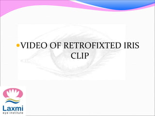 VIDEO OF RETROFIXTED IRIS
CLIP
 