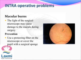 INTRA operative problems
Macular burns
 The light of the surgical
microscope may cause
damage to the macula during
surgery
Prevention
 Use a protecting filter on the
microscope or cover the
pupil with a surgical sponge
.
 