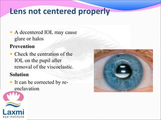 Lens not centered properly
 A decentered IOL may cause
glare or halos
Prevention
 Check the centration of the
IOL on the pupil after
removal of the viscoelastic.
Solution
 It can be corrected by re-
enclavation
 