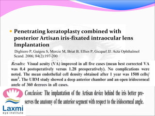  Penetrating keratoplasty combined with
posterior Artisan iris-fixated intraocular lens
Implantation
Dighiero P, Guigou S, Mercie M, Briat B, Ellies P, Gicquel JJ. Acta Ophthalmol
Scand. 2006; 84(2):197-200
 
