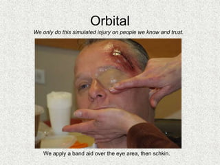 Orbital
We apply a band aid over the eye area, then schkin.
We only do this simulated injury on people we know and trust.
 