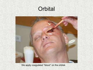 Orbital
We apply coagulated “blood” on the orbital.
 
