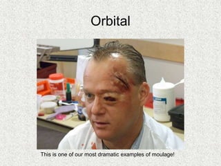 Orbital
This is one of our most dramatic examples of moulage!
 