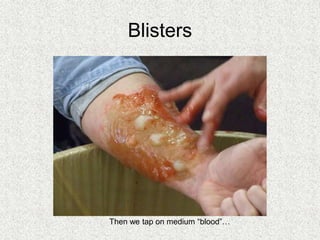 Blisters
Then we tap on medium “blood”…
 