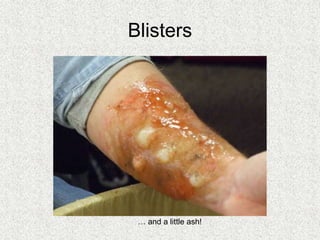 Blisters
… and a little ash!
 