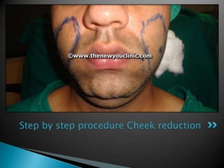 Step by step procedure Cheek reduction
 