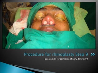Procedure for rhinoplasty Step 9
          osteotomitis for correction of bony deformity2
 