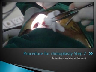 Procedure for rhinoplasty Step 2
              Deviated nose and wide ala (big nose)
 