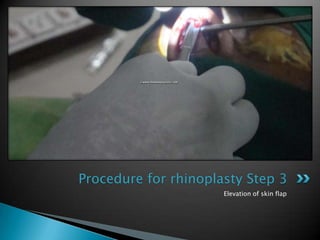 Procedure for rhinoplasty Step 3
                      Elevation of skin flap
 