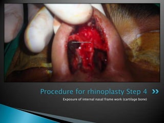 Procedure for rhinoplasty Step 4
      Exposure of internal nasal frame work (cartilage bone)
 