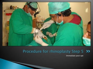 Procedure for rhinoplasty Step 5
                      Immediate post opt
 