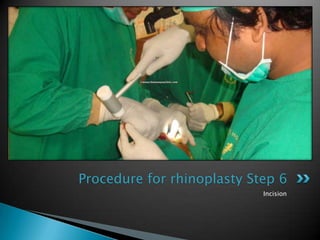 Procedure for rhinoplasty Step 6
                            Incision
 