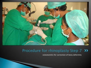 Procedure for rhinoplasty Step 7
          osteotomitis for correction of bony deformity
 