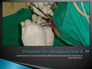 Procedure for rhinoplasty Step 8
osteotomitis for correction of bony deformity1osteotomitis for correction of
                                                           bony deformity1
 