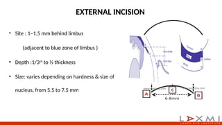 Small Incision Cataract Surgery steps.pptx