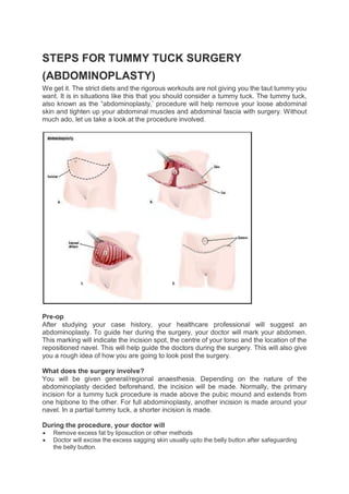 STEPS FOR TUMMY TUCK SURGERY.pdf